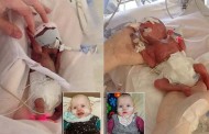 Φωτογραφίες: Δίδυμα γεννήθηκαν στις 23 εβδομάδες και επέζησαν!