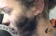 Τρομερές εικόνες: Εξερράγησαν τα ακουστικά που είχε στα αυτιά της εν μέσω πτήσης