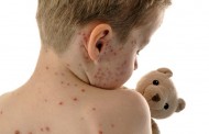 Ραγδαία αύξηση κρουσμάτων ιλαράς στο Duisburg – Τι πρέπει αν προσέξουν οι γονείς